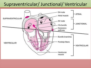 Supraventricular/ Junctional/ Ventricular
 