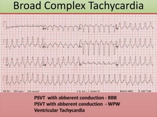Broad Complex Tachycardia
 