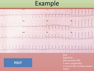 Example
Rate
Regularity
Narrow/wide QRS
P wave morphology
P wave & QRS complex relation
Others
PSVT
 