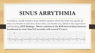 ELECTROCARDIOGRAPHY (ECG) INTERPRETATION.pptx