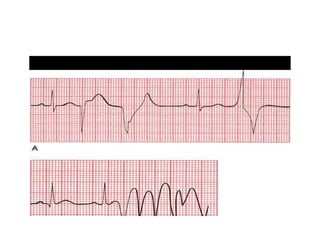 Electrocardiography II.pptx interpretation and analysing ecg strips | PPTX