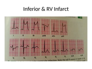 Preload Effected Rv Infarct Electrocardiography II.pptx interpretation and analysing ecg strips | PPTX