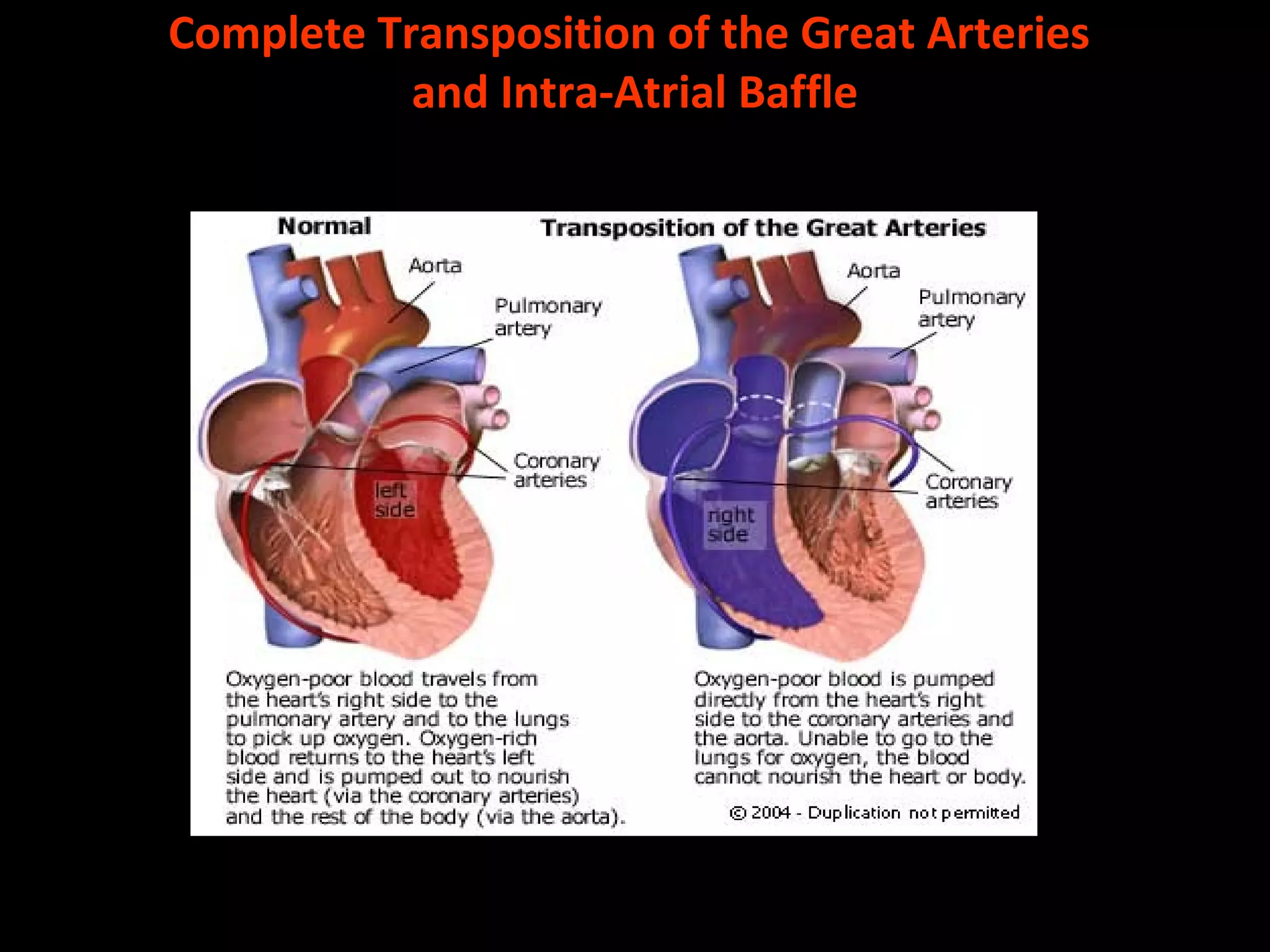 Complete Transposition Adult Congenital Heart Disease Navigating the Local Care Landscape: A Resource Guide