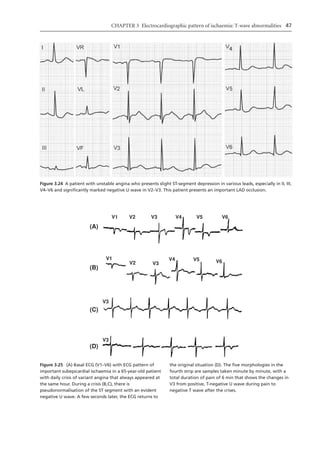 Electrocardiography In Ischaemic Heart Disease Clinical And Imagine ...