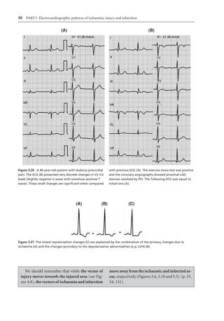 Electrocardiography In Ischaemic Heart Disease Clinical And Imagine ...