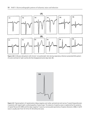 Electrocardiography In Ischaemic Heart Disease Clinical And Imagine ...