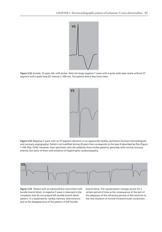 Electrocardiography In Ischaemic Heart Disease Clinical And Imagine ...