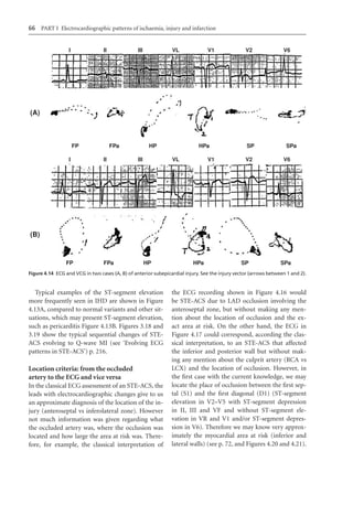 Electrocardiography In Ischaemic Heart Disease Clinical And Imagine ...