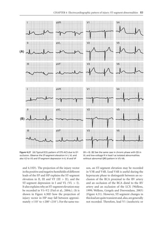 Electrocardiography In Ischaemic Heart Disease Clinical And Imagine ...