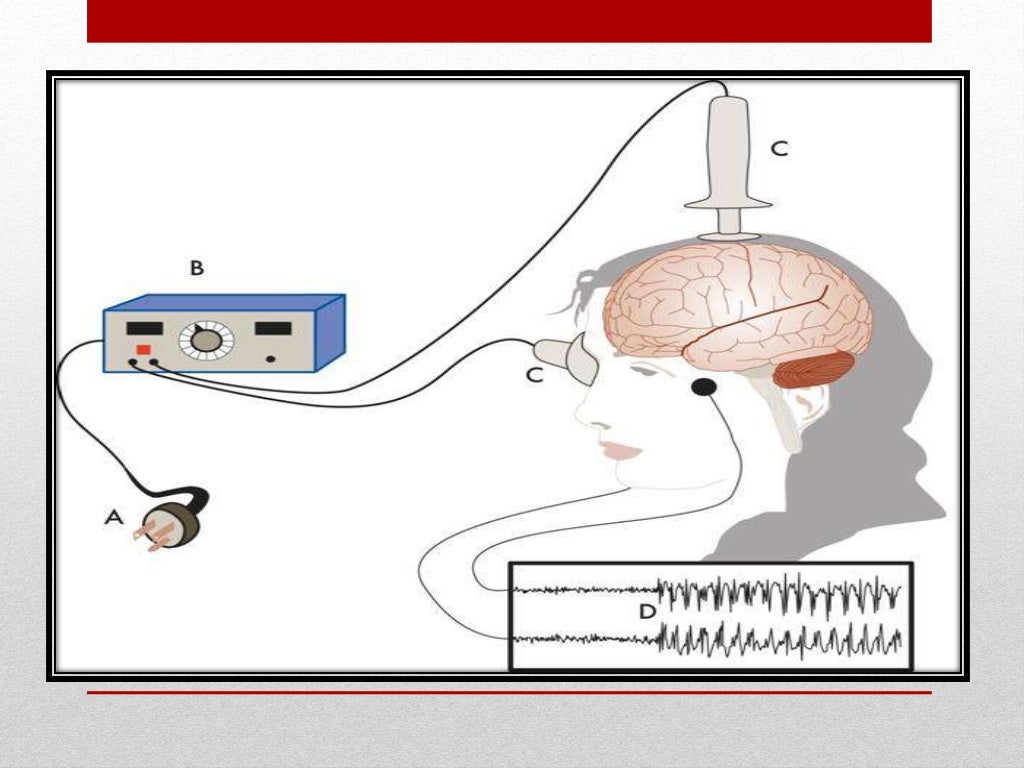 Electroconvulsive therapy