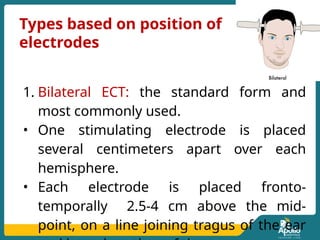electroconvulsive therapy ECT .presentation | PPTX