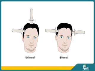 electroconvulsive therapy ECT .presentation | PPTX