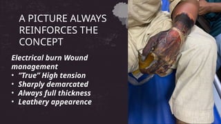 Electrical burn Wound
management
• ”True” High tension
• Sharply demarcated
• Always full thickness
• Leathery appearence
A PICTURE ALWAYS
REINFORCES THE
CONCEPT
 