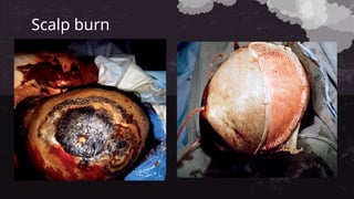 Scalp burn
 