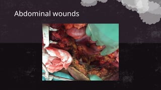 Abdominal wounds
 