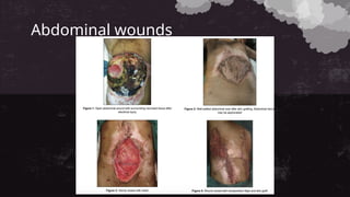 Abdominal wounds
 