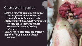 -Internal injuries both directly under
contact points and remotely as
result of late ischemic necrosis
-Patients must be frequently evaluated
for changes in their abdominal
examination and/or feeding
tolerance.
-Deterioration mandates laparotomy.
-Repair of large abdominal wall
wounds
Chest wall injuries
 