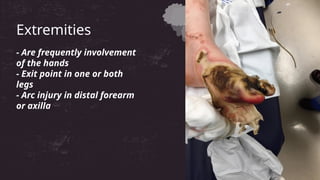 Extremities
- Are frequently involvement
of the hands
- Exit point in one or both
legs
- Arc injury in distal forearm
or axilla
 