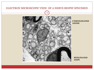 ELECTRON MICROSCOPIC VIEW OF A NERVE BIOPSY SPECIMEN
6
UNMYELINATED
AXONS
MYELINATED
AXON
 