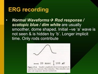 ERG recording Normal Waveforms   Rod response / scotopic blue / dim white  are usually smoother, dome shaped. Initial –ve ‘a’ wave is not seen & is hidden by ‘b’. Longer implicit time. Only rods contribute 
