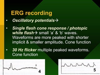 ERG recording Oscillatory potentials    Single flash cone response / photopic white flash   small ‘a’ & ‘b’ waves. Waveforms are more peaked with shorter implicit & smaller amplitude. Cone function 30 Hz flicker  multiple peaked waveforms. Cone function 4 5 
