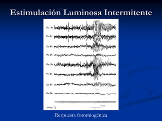 Respuesta fotomiogénica
Estimulación Luminosa Intermitente
 