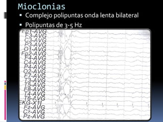 Mioclonias
 Complejo polipuntas onda lenta bilateral
 Polipuntas de 3-5 Hz
 