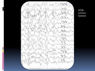 Sd de
Lennox-
Gastaut
 