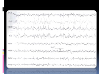 Electroencefalograma (eeg) en epilepsia
