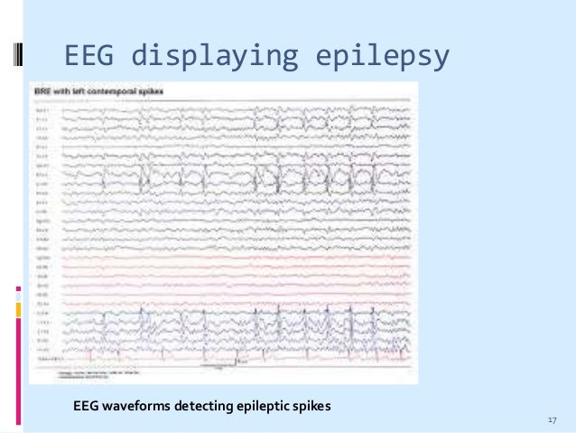 Résultat d'images pour electroencéphalogramme epilepsie