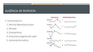AUSÊNCIA DE RESPOSTA
 Encontrada em:
1. Retinite Pigmentosa tardia
2. DR total
3. Coroiderémia
4. Amaurose congénita de Leber
5. Coriorretinite luética
 