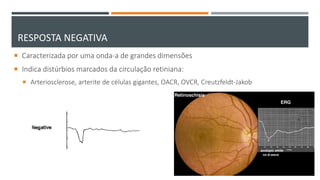 RESPOSTA NEGATIVA
 Caracterizada por uma onda-a de grandes dimensões
 Indica distúrbios marcados da circulação retiniana:
 Arteriosclerose, arterite de células gigantes, OACR, OVCR, Creutzfeldt-Jakob
 