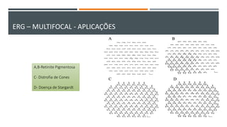 A,B-Retinite Pigmentosa
C- Distrofia de Cones
D- Doença de Stargardt
ERG – MULTIFOCAL - APLICAÇÕES
 