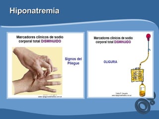 Hiponatremia 