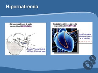 Hipernatremia 