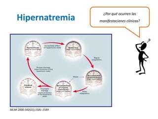 Hipernatremia 
¿Por qué ocurren las manifestaciones clínicas? 
NEJM 2000:342(21);1581-1589  