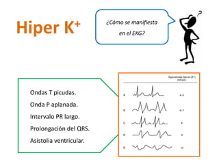 Ondas T picudas. 
Onda P aplanada. 
Intervalo PR largo. 
Prolongación del QRS. 
Asistolia ventricular. 
¿Cómo se manifiesta en el EKG? 
HiperK+  