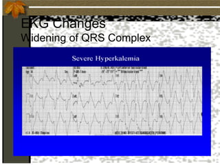 EKG Changes
Widening of QRS Complex
 