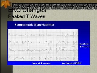 EKG Changes
Peaked T Waves
 