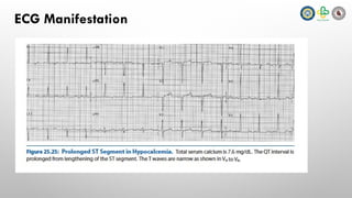 Electrolyte Abnormalities and ECG Findings | PPTX