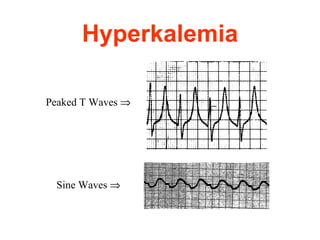 Hyperkalemia Peaked T Waves   Sine Waves   