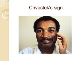 Chvostek’s sign
 