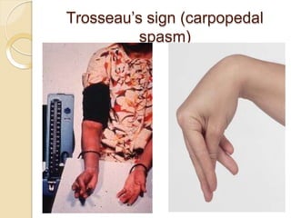Trosseau’s sign (carpopedal
spasm)
 