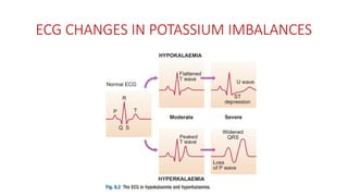 ECG CHANGES IN POTASSIUM IMBALANCES
 