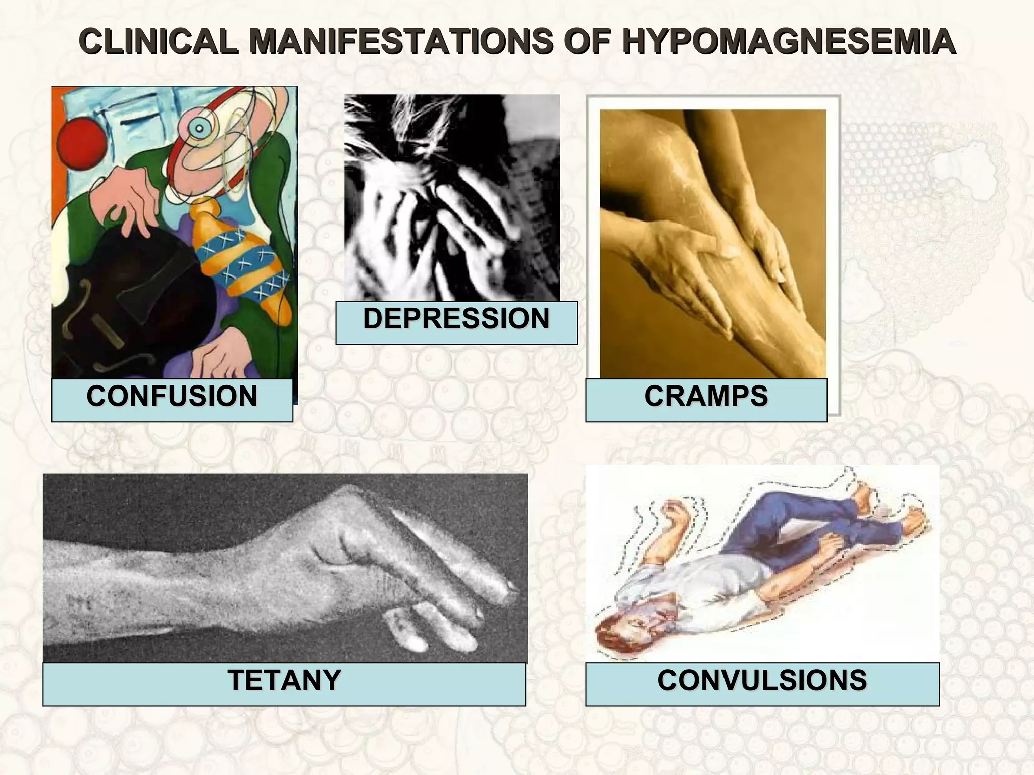 CLINICAL MANIFESTATIONS OF HYPOMAGNESEMIACLINICAL MANIFESTATIONS OF HYPOMAGNESEMIA
CONFUSIONCONFUSION
DEPRESSIONDEPRESSION
CRAMPSCRAMPS
TETANYTETANY CONVULSIONSCONVULSIONS
 
