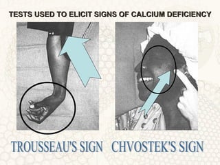 TESTS USED TO ELICIT SIGNS OF CALCIUM DEFICIENCYTESTS USED TO ELICIT SIGNS OF CALCIUM DEFICIENCY
 