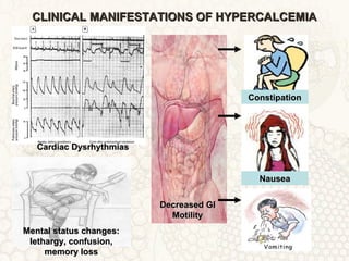CLINICAL MANIFESTATIONS OF HYPERCALCEMIACLINICAL MANIFESTATIONS OF HYPERCALCEMIA
Decreased GIDecreased GI
MotilityMotility
Cardiac DysrhythmiasCardiac Dysrhythmias
ConstipationConstipation
NauseaNausea
Mental status changes:Mental status changes:
lethargy, confusion,lethargy, confusion,
memory lossmemory loss
 
