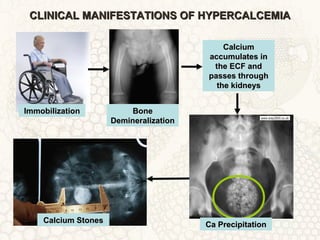 CLINICAL MANIFESTATIONS OF HYPERCALCEMIACLINICAL MANIFESTATIONS OF HYPERCALCEMIA
ImmobilizationImmobilization BoneBone
DemineralizationDemineralization
CalciumCalcium
accumulates inaccumulates in
the ECF andthe ECF and
passes throughpasses through
the kidneysthe kidneys
Ca PrecipitationCa PrecipitationCalcium StonesCalcium Stones
 