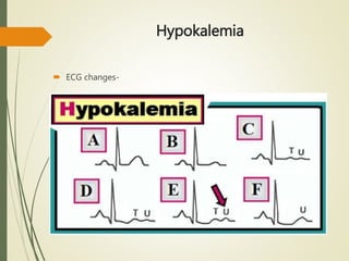 Hypokalemia
 ECG changes-
 