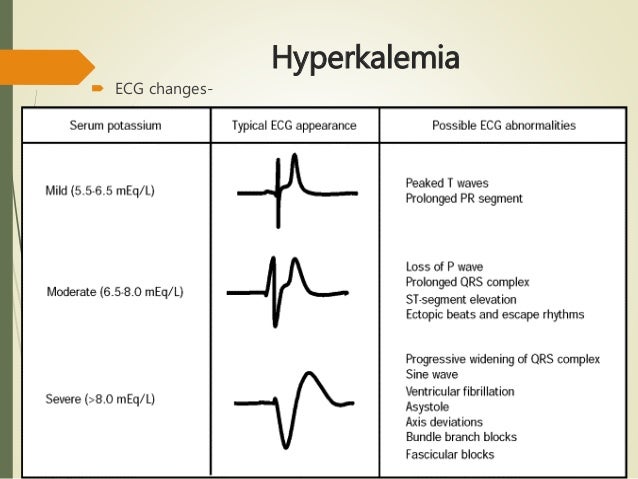 hyperkalemia ecg findings wikimedia hyperkalemia ecg findings wikimedia